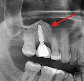 Depois - Primeiro Osteoindutor