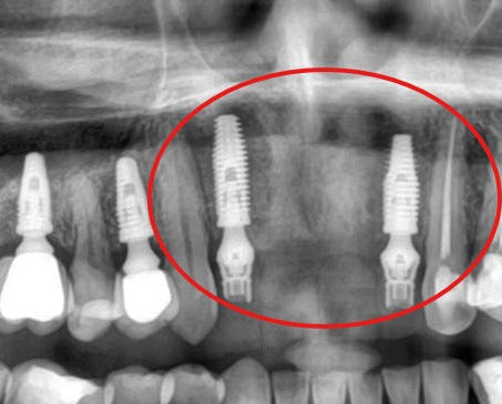 Antes - Primeiro Osteoindutor