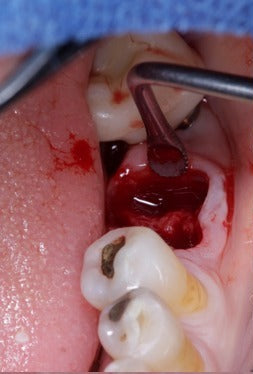 Depois - Preservação Alveolar Pós-Exodontia