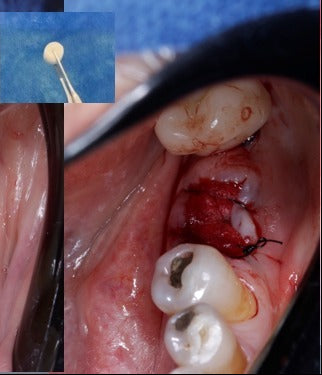 Antes - Preservação Alveolar Pós-Exodontia