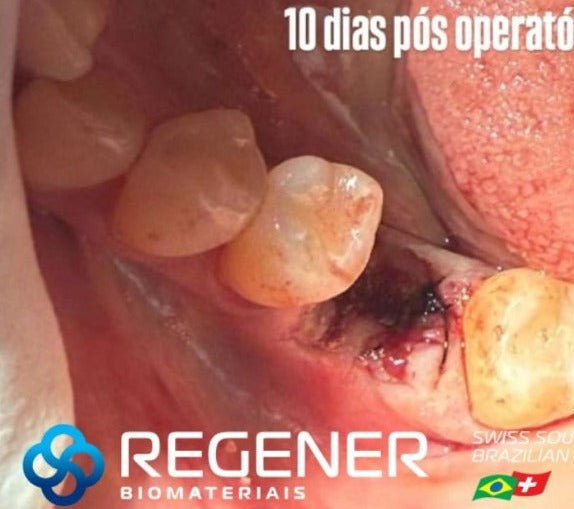 Antes - Mais Controle, Proteção e Previsibilidade Cirúrgica